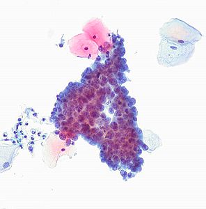 Papanicolaou smear